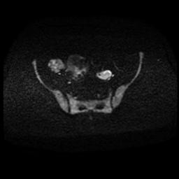 Carcinoma of the cervix (Radiopaedia 89018-105858 Axial DWI 60).jpg