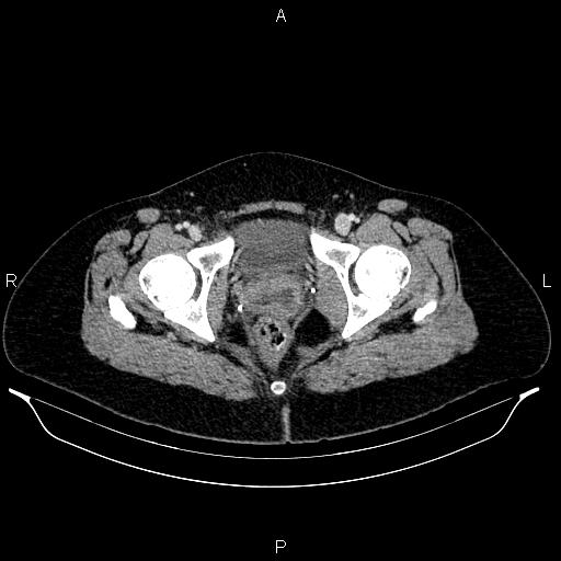 Carcinoma of uterine cervix (Radiopaedia 85861-101700 A 74).jpg