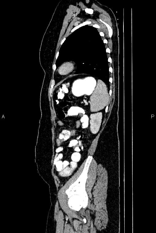 Carcinoma of uterine cervix (Radiopaedia 85861-101700 D 69).jpg