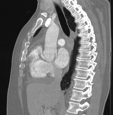 Cardiac sarcoidosis (Radiopaedia 74548-85534 Sagittal lung window 49).jpg