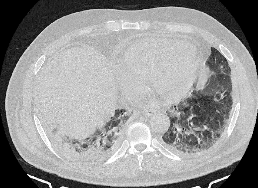Cardiogenic pulmonary edema (Radiopaedia 68180-77678 Axial lung window 77).jpg
