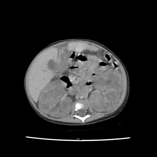 Caroli disease with autosomal recessive polycystic kidney disease (ARPKD) (Radiopaedia 89651-106703 B 111).jpg