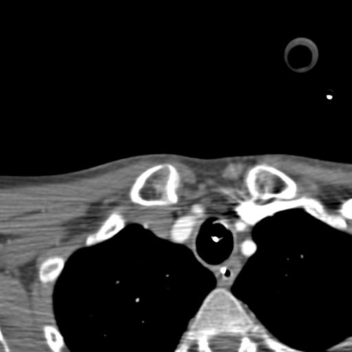 File:Carotid arterial dissection (Radiopaedia 30001-30548 B 19).jpg