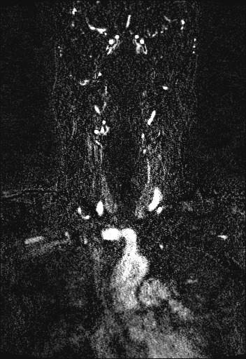 File:Carotid artery dissection (Radiopaedia 28441-28689 Coronal MRA 28).jpg