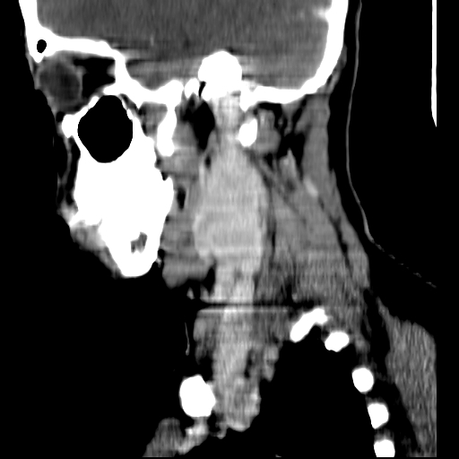 File:Carotid body tumor (Radiopaedia 27890-28124 C 18).jpg