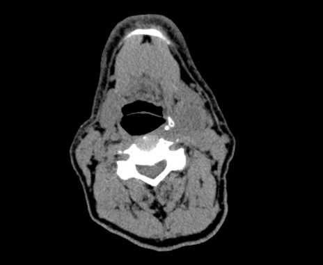 File:Carotid body tumor (Radiopaedia 61750-69757 Axial non-contrast 49).jpg