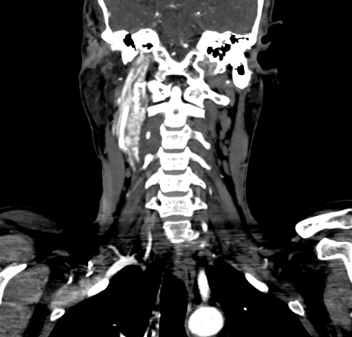 File:Carotid body tumor (Radiopaedia 83615-98727 B 76).jpg