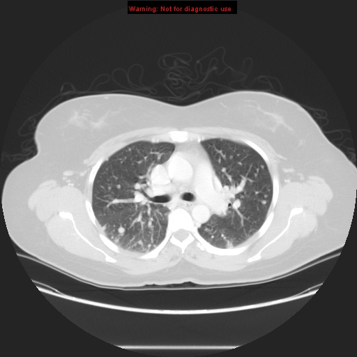 Carotid body tumor with lung metastases (Radiopaedia 9301-48390 Axial lung window 30).jpg