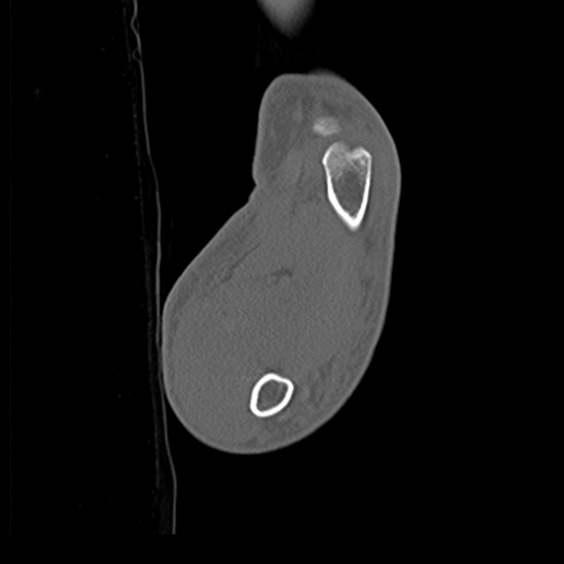 File:Carpo-metacarpal fracture-dislocations with hamatum split fracture (Radiopaedia 18482-18343 Sagittal bone window 35).jpg