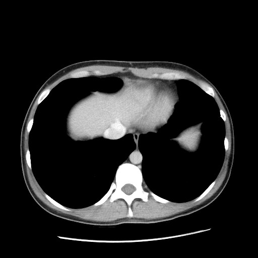 File:Castleman disease with fibrous pseudotumor in the abdomen (Radiopaedia 77296-89373 A 13).jpg