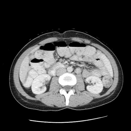 Castleman disease with fibrous pseudotumor in the abdomen (Radiopaedia 77296-89373 A 59).jpg