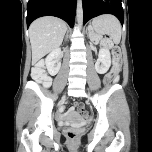 Castleman disease with fibrous pseudotumor in the abdomen (Radiopaedia 77296-89373 B 57).jpg