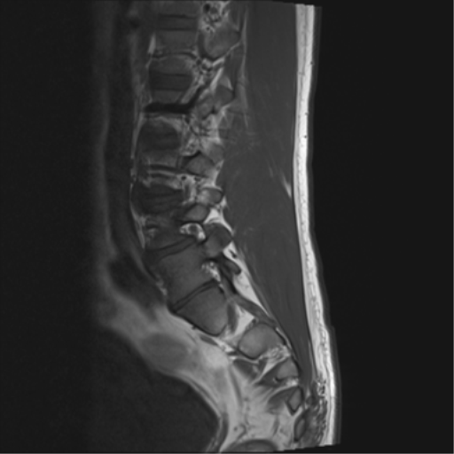 File:Cauda equina syndrome (Radiopaedia 53615-59672 Axial T1 13).png