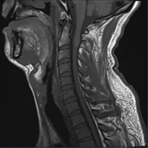 File:Cavernoma of cervical cord (Radiopaedia 50838-56347 Sagittal T1 8).png