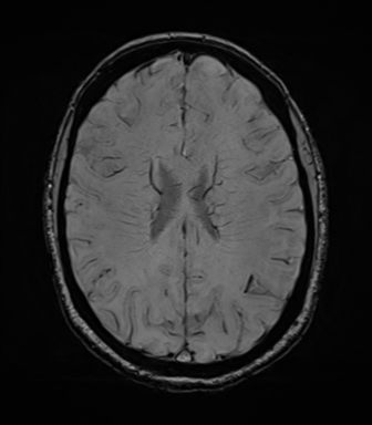 File:Cavernoma with bleed - midbrain (Radiopaedia 54546-60773 Axial SWI 31).png