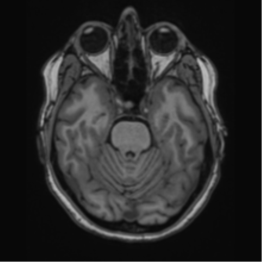 Cavernoma with bleed - midbrain (Radiopaedia 54546-60774 Axial T1 8).png