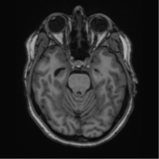 Cavernoma with bleed - midbrain (Radiopaedia 54546-60774 Axial T1 9).png