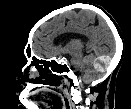 Cavernous hemangioma of the cerebellar falx (Radiopaedia 73025-83723 B 183).jpg
