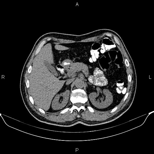 Cecal adenocarcinoma (Radiopaedia 85324-100916 Axial non-contrast 27).jpg