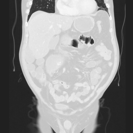 Cecal volvulus (Radiopaedia 75378-86620 Coronal lung window 59).jpg