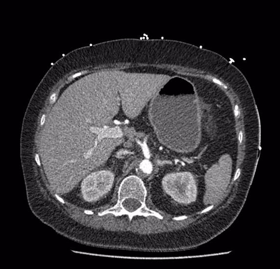 Celiac artery severe stenosis and dissection (Radiopaedia 44128-47842 B 24).jpg