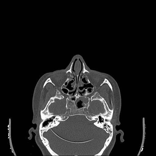 File:Cemento-ossifying fibroma (Radiopaedia 21243-21149 Axial bone window 2).jpg