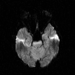 File:Central-variant posterior reversible encephalopathy syndrome (PRES) (Radiopaedia 43880-47358 Axial DWI 7).jpg