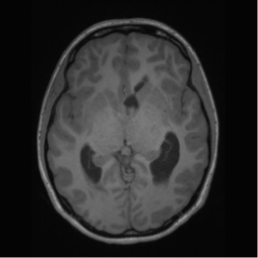File:Central neurocytoma (Radiopaedia 37664-39557 Axial T1 33).png