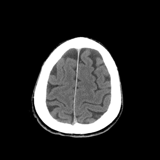 Central neurocytoma (Radiopaedia 68725-78432 Axial C+ 82).jpg