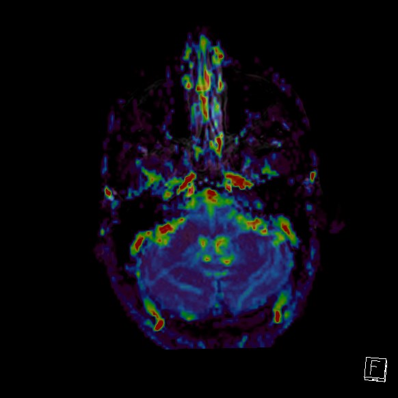Central neurocytoma (Radiopaedia 84497-99872 Axial Perfusion 248).jpg