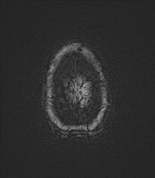 File:Central neurocytoma (Radiopaedia 84497-99872 Axial SWI 68).jpg