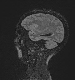 Central neurocytoma (Radiopaedia 84497-99872 Sagittal Flair + Gd 43).jpg