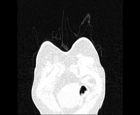 Centrilobular pulmonary emphysema (Radiopaedia 62468-70718 Coronal lung window 3).jpg