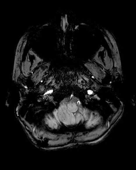 Cerebellar abscess (Radiopaedia 73727-84563 Axial SWI 10).jpg