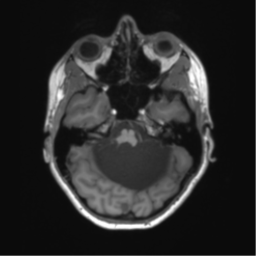 Cerebellar agenesis with hypoplastic pons (pontocerebellar hypoplasia) (Radiopaedia 57224-64138 Axial T1 23).png