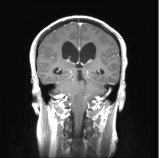 Cerebellar ependymoma complicated by post-operative subdural hematoma (Radiopaedia 83322-97736 Coronal T1 C+ 34).png