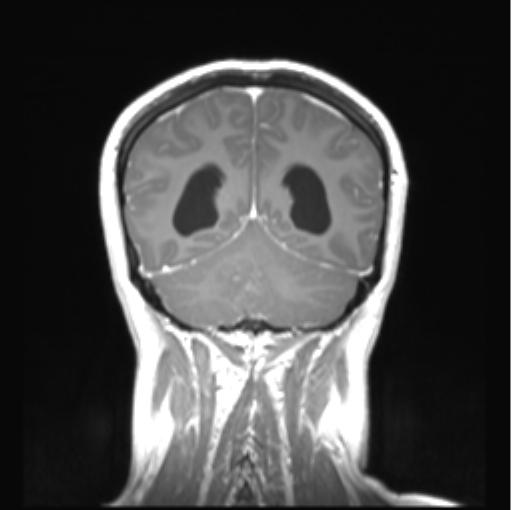 Cerebellar ependymoma complicated by post-operative subdural hematoma (Radiopaedia 83322-97736 Coronal T1 C+ 43).png