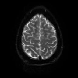 Cerebellar hemangioblastoma (Radiopaedia 29570-30077 Axial DWI 48).jpg
