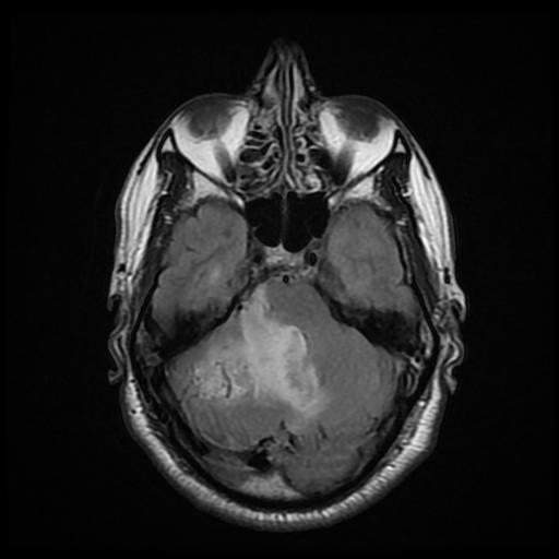 File:Cerebellar hemangioblastoma (Radiopaedia 88055-104622 Axial FLAIR 10).jpg