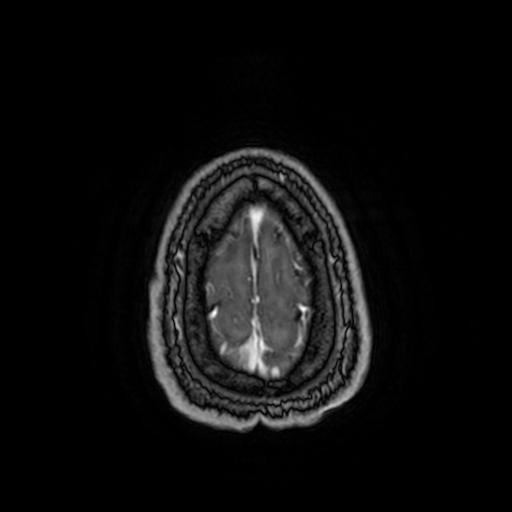 Cerebellar hemangioblastoma (Radiopaedia 88055-104622 Axial T1 C+ 159).jpg