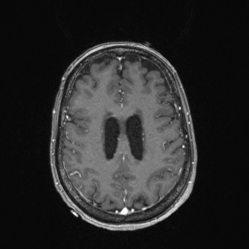 Cerebellar metastases (Radiopaedia 24038-24249 Axial T1 C+ 2).jpg
