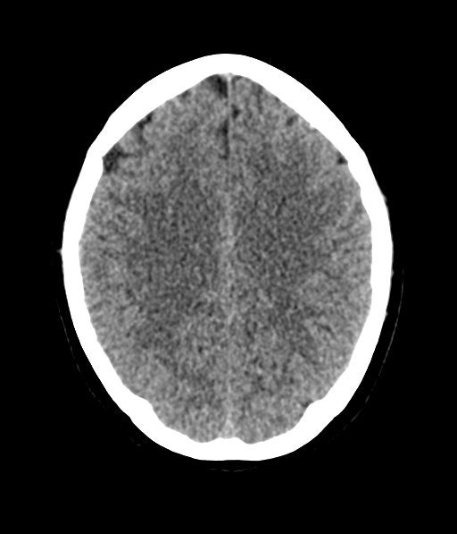 Cerebellar metastases - colorectal adenocarcinoma (Radiopaedia 40947-43652 Axial non-contrast 45).png