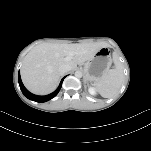 File:Cerebellar metastasis - adenocarcinoma lung (Radiopaedia 63184-71717 Axial C+ delayed 65).png