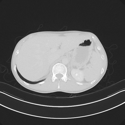 Cerebellar metastasis - adenocarcinoma lung (Radiopaedia 63184-71717 Axial lung window 67).png