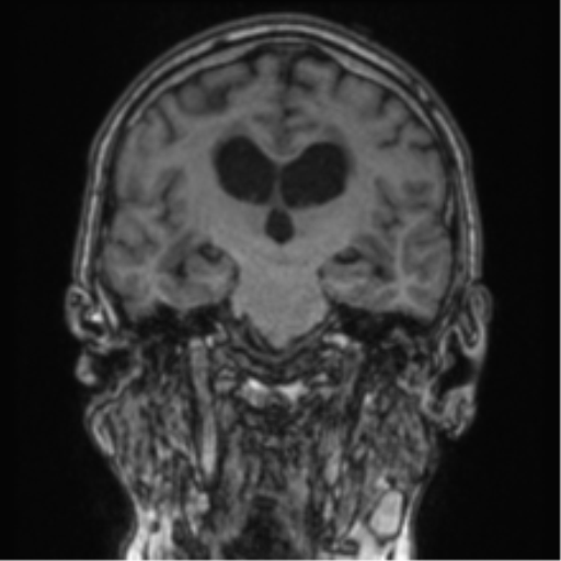 Cerebellar metastasis from lung adenocarcinoma (Radiopaedia 86690-102829 Coronal T1 51).png