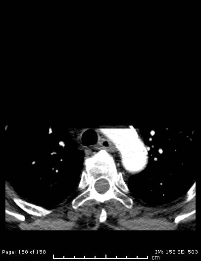 Cerebellar strokes due to intracranial giant cell arteritis (Radiopaedia 68799-78510 CT angiogram 158).jpg