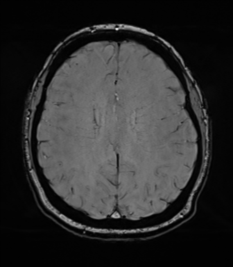 Cerebellopontine angle meningioma (Radiopaedia 48434-53348 Axial SWI 61).png