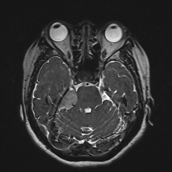 File:Cerebellopontine angle meningioma (Radiopaedia 53561-59591 Axial 3D volume T2 75).jpg