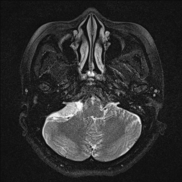 File:Cerebellopontine angle meningioma (Radiopaedia 53561-59591 Axial T2 fat sat 8).jpg