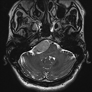 Cerebellopontine angle meningioma (Radiopaedia 72983-83680 Axial FIESTA 17).jpg